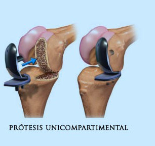 Prótesis Unicompartimental